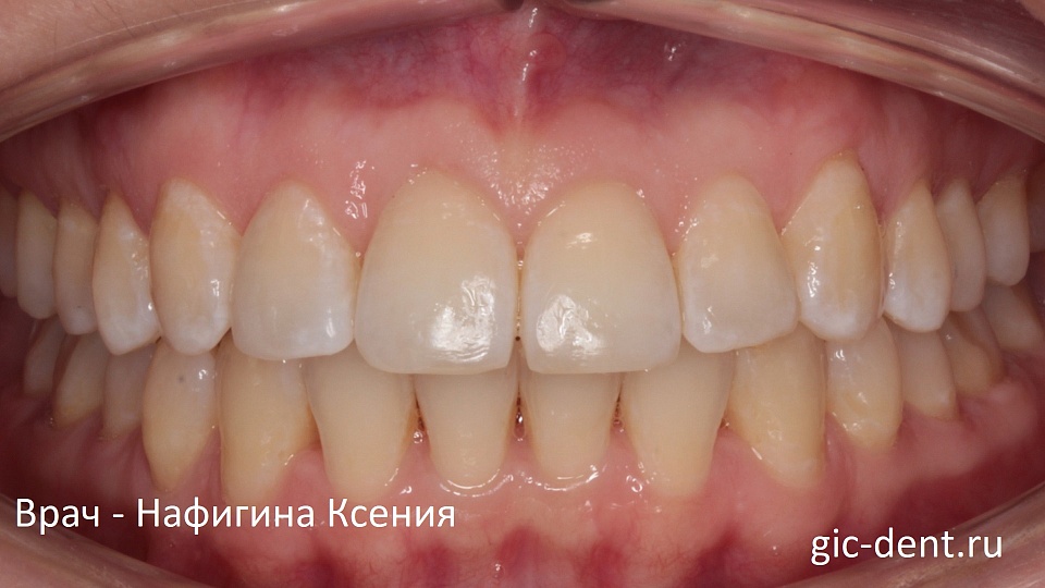 Неправильное смыкание челюстей после предыдущего ортодонтического лечения